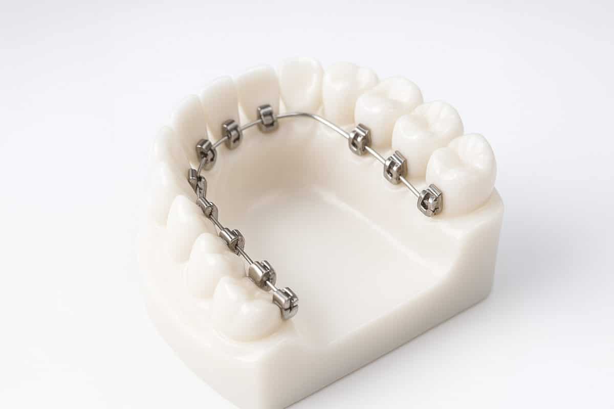 lingual-bracket-systems-thai-dental-schools-01