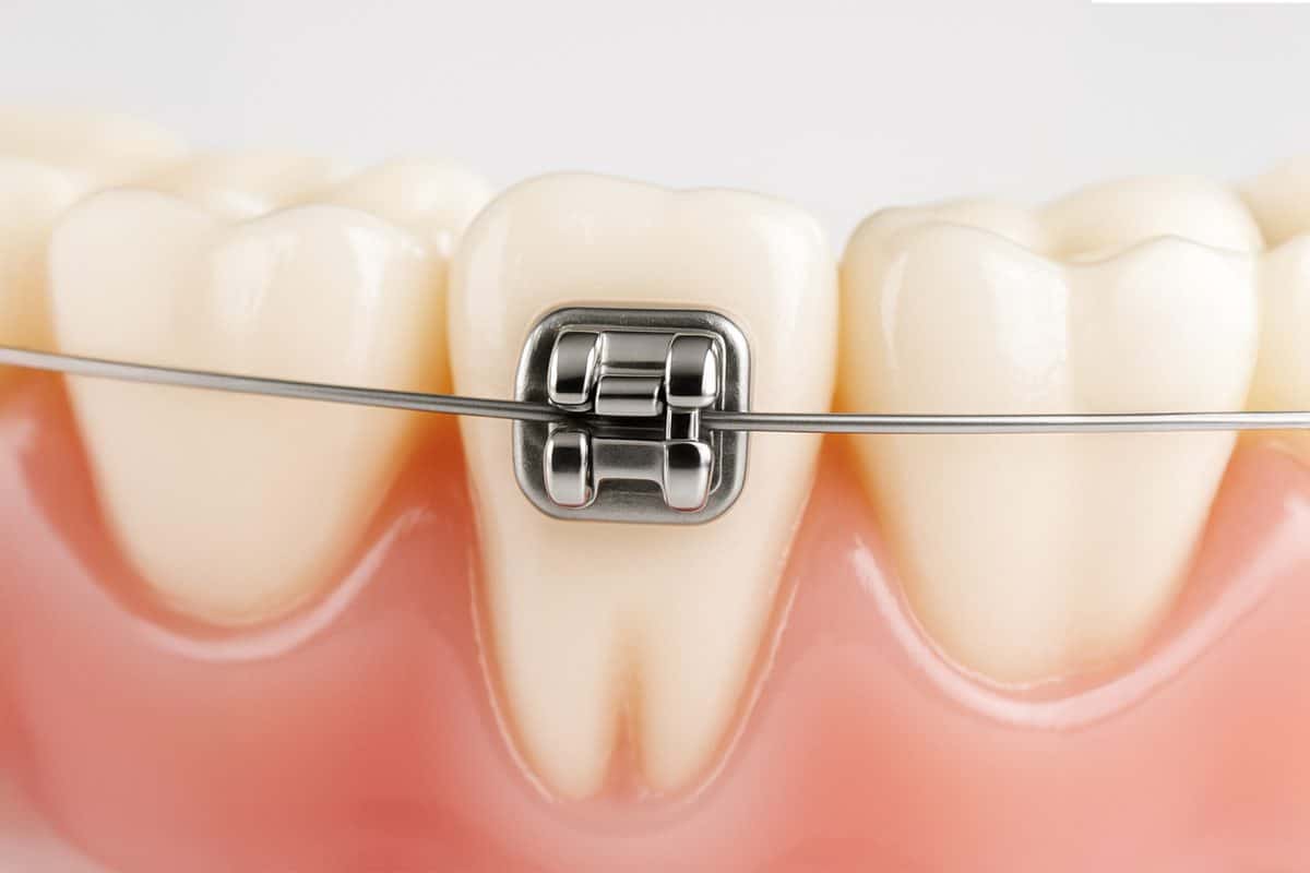 orthodontic-care-thailand-self-ligating-01