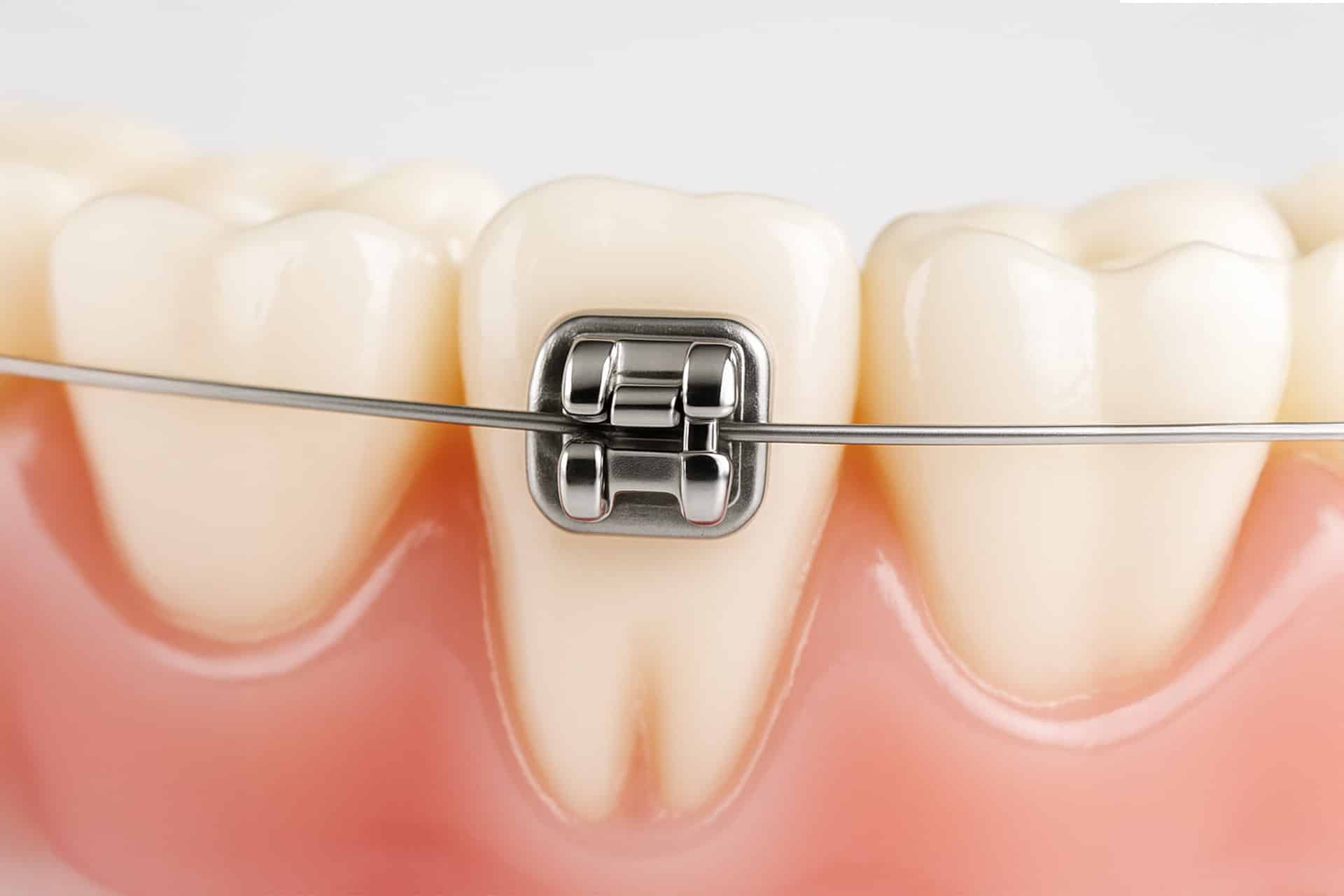 orthodontic-care-thailand-self-ligating-01