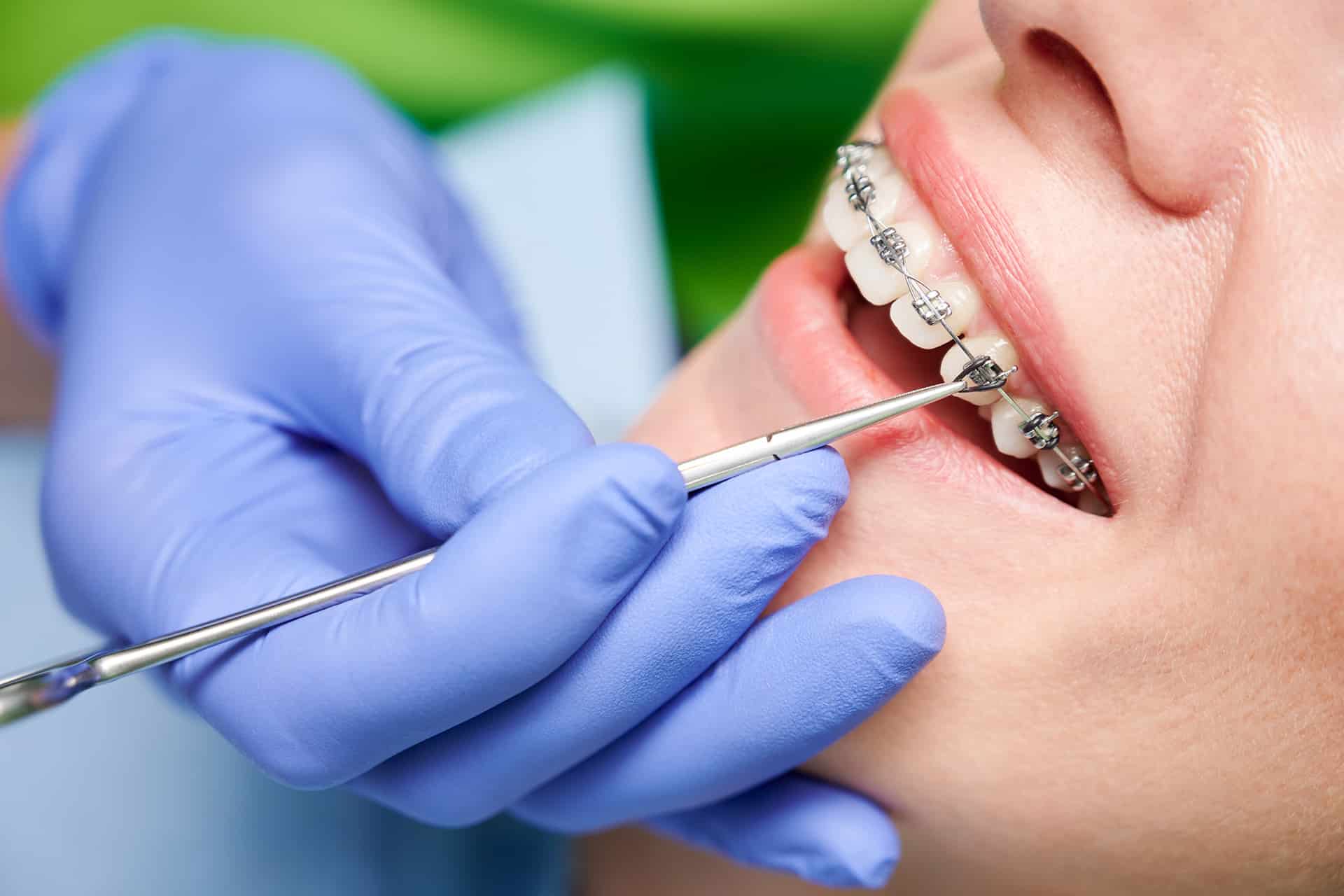 traditional-brackets-self-ligating-brackets-or-clear-aligners-which-is-best-for-you-013