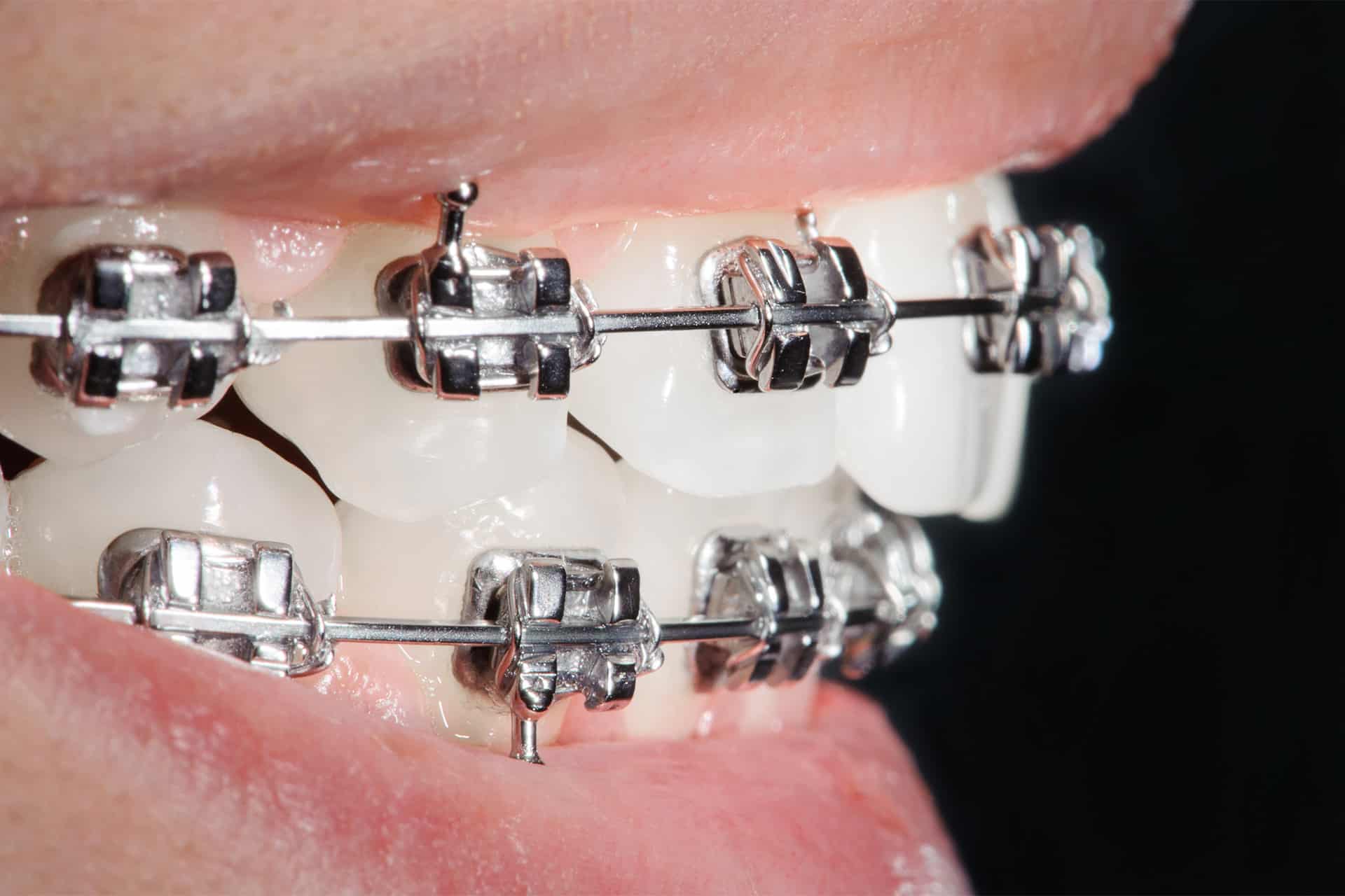 traditional-brackets-self-ligating-brackets-or-clear-aligners-which-is-best-for-you-02